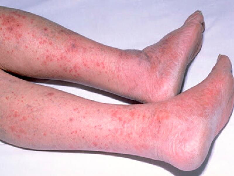 Последствия грибка